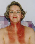 Photo of post radiotherapy neck burn 8 days after treatment finishediotherapy