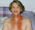 Photo  of neck burns 16 days after radiotherapy