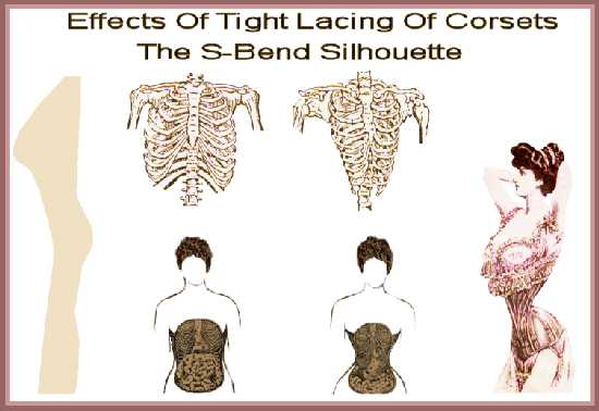 effects of tight lacing of corsets the s-bend silhouette edwardian fashion edwardian Corsetry